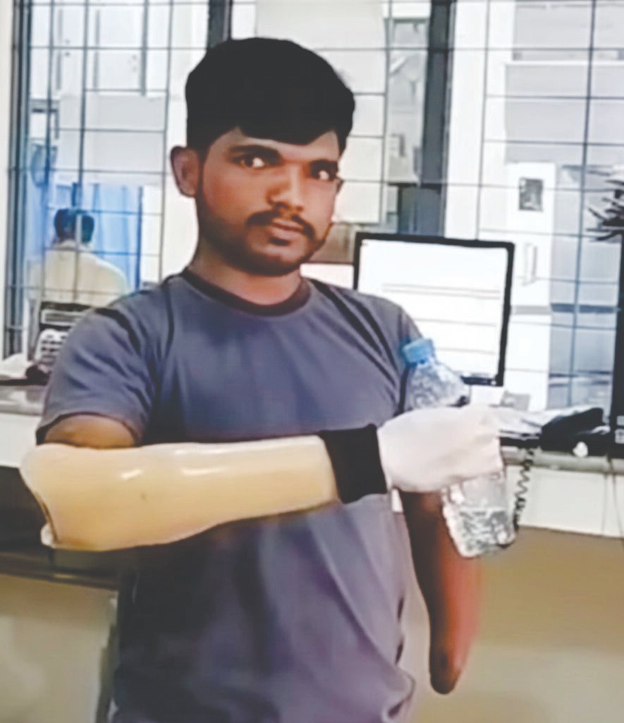 Myoelectric Hand